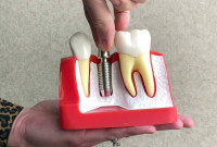 Dental Implant Treatment in Chinchwad