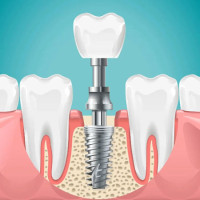 Kids Dental Clinic in Hyderabad | Best Kids Dental Clinic in Secunderabad