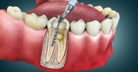 Best Root Canal Treatment in Noida | Dr Gul's Dental Clinic Noida