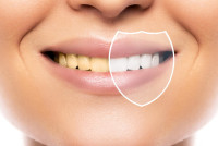 Teeth Whitening Clinic in Hubli