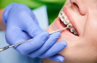 Braces Treatment Cost Noida | Dr Guls Dental Clinic