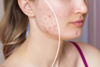 Acne Scar Treatment in Riyadh