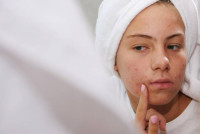 Acne Treatment in Riyadh
