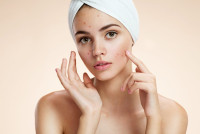 Best acne scar treatment in islamabad