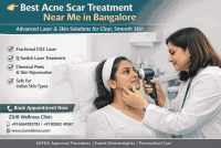 Acne Scar Treatment Near Me in Bangalore
