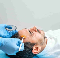 Best Chemical Peel Treatment in Bengaluru