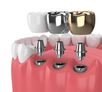 Best Dental Clinic in Madurai
