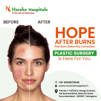 General Plastic Surgery in Kompally, Hyderabad | Harsha Hospital