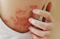 Can a dermatologist treat scalp eczema with better tools