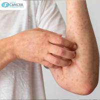 Low Cost Skin Cancer Treatment in India