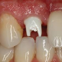 Dental Bonding Cementing in Dubai