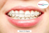 Transform Your Smile with Invisible Teeth Braces