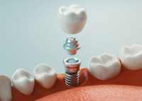 Advanced Dental Clinic in Noida | Complete Smile Care