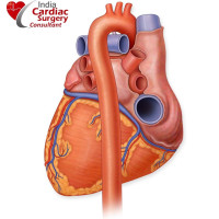 Low Cost Robotic Cardiac Surgery in india