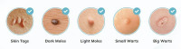 ***** Skin Tag Remover Benefits & Reviews [2024]: Flaunt Your Skin