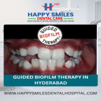 Guided Biofilm Therapy Cost in Hyderabad – GBT Dental Care