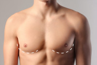 Gynecomastia Surgery in Riyadh