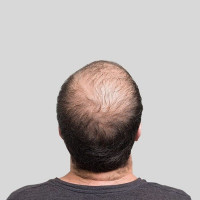 Hair transplant treatment in Islamabad