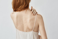 How to Treat Back Acne and Its Effects?