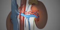 Kidney Transplant Hospitals in India for Ethiopian Patients