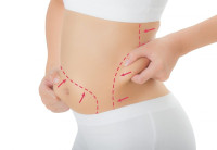 Laser Liposuction in Riyadh