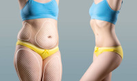 What to Expect During Your Consultation for Liposuction Surgery in Riyadh