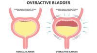 Overactive Bladder Treatment in Pune | Dr. Rakshit Ahuja