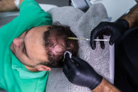PRP Hair Treatment in Riyadh
