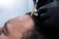 PRP hair treatment in Riyadh
