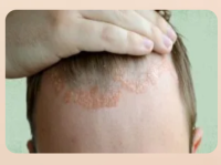 Skin Fungal Infection Treatment