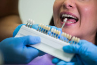 Transform Your Smile with Dental Veneers - Plus Dental Clinic