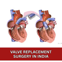Low Cost Valve Replacement Surgery India