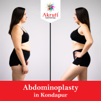 Abdominoplasty in Kondapur