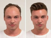 Hair Transplant in Islamabad