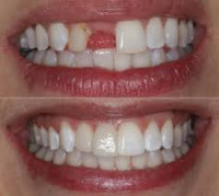 Expert Bridges & Crowns Dentistry Islamabad
