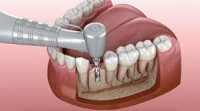 dental implants in los algodones