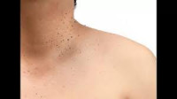 Utopia Skin Tag Remover (Pros and Cons) Is It Scam Or Trusted?