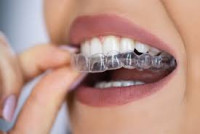 Best Teeth Braces for Adults – Modern Smile Solutions