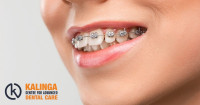 Braces Treatment in Nayapalli | Best Orthodontic Treatment