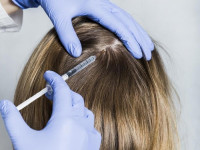 Exosomes Hair Therapy in Islamabad