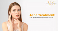 ACNE TREATMENT: GET TREATED BEFORE IT LEAVES A SCAR
