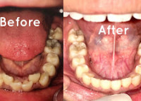 Why Do Teeth Become Yellow Even If You Brush Every Day?