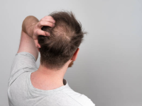 Hair Fall Treatment in Noida