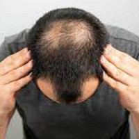 Hairloss Treatment in Islamabad