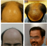 Best Hair Transplant Surgeon in Bengaluru
