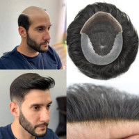 Hair Patch Centre| best hair replacement service