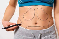 Cost of Liposuction in Islamabad: The Complete Breakdown