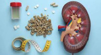 Do Natural Kidney Stones Dissolvers Really Work?