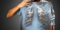 Best Lung Cancer Doctor in Delhi - Dr Sabyasachi Bal