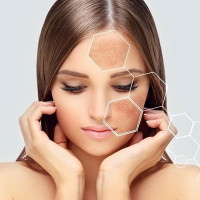 Melasma in Islamabad Pakistan